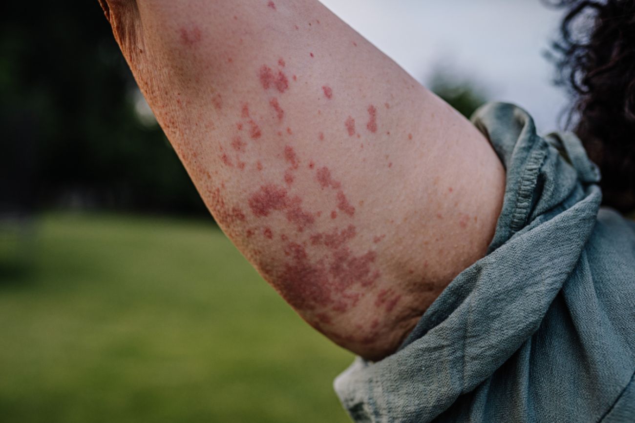 Close-up of a woman's arm showing a rash caused by Human Parvovirus (Parvovirus B19), standing outdoors on grass.